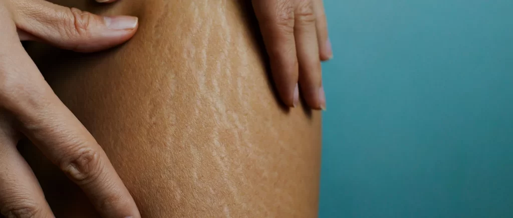 Stretch Marks
