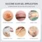 Advanced Scar Gel Applications